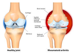Physical Therapists Tips to Prevent Arthritis