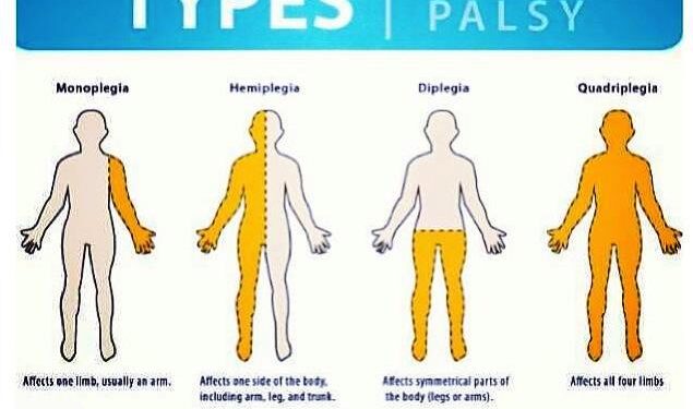 Importance of Physical Therapy for Cerebral Palsy