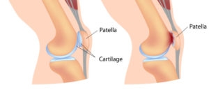 Chondromalacia-Patellae-CardioFlexTherapy