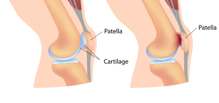 Knee Pain? Symptoms of Chondromalacia