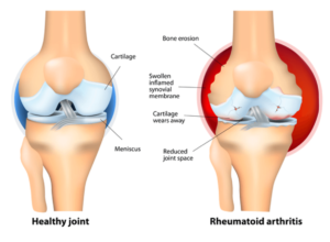 Arthritis explanation at CardioFlex Therapy