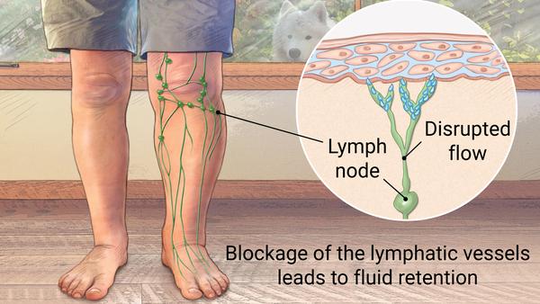 How Physical Therapy can help Lymphedema patients in Davie & Miami?